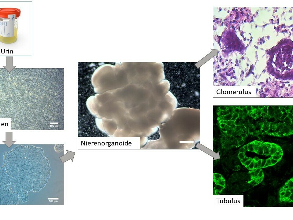 Die Abbildung zeigt die Vorgehensweise, Nierenorganoide aus Urinstammzellen-generierten induzierten pluripotenten Stammzellen (iPSCs) zu generieren. Daraus entstandene Nierenstrukturen: Glomerulus, bedeckt von spezialisierten Epithelzellen, bekannt als Podozyten, und Tubuli